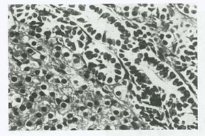 بيماريهاي تخمدان و لوله هاي رحمي چیست؟(1)